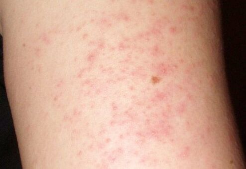 Itchy skin rashes - a symptom of the presence of worms in the liver